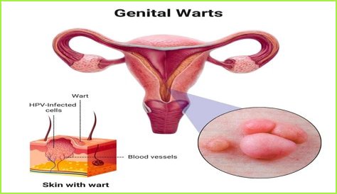 Can genital warts appear during pregnancy?